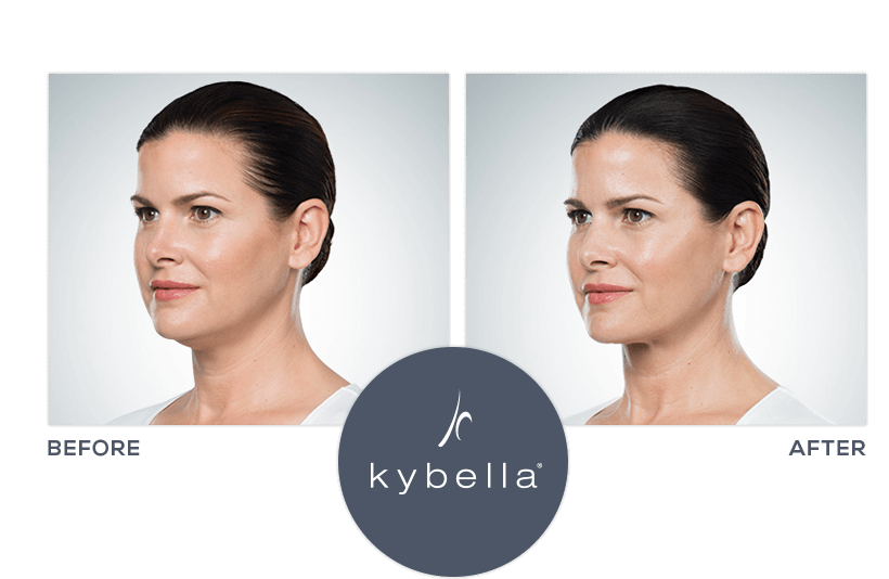 Kybella before and after