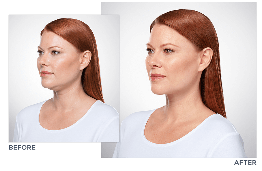 Chin Sculpting, Permanent Double Chin Removal